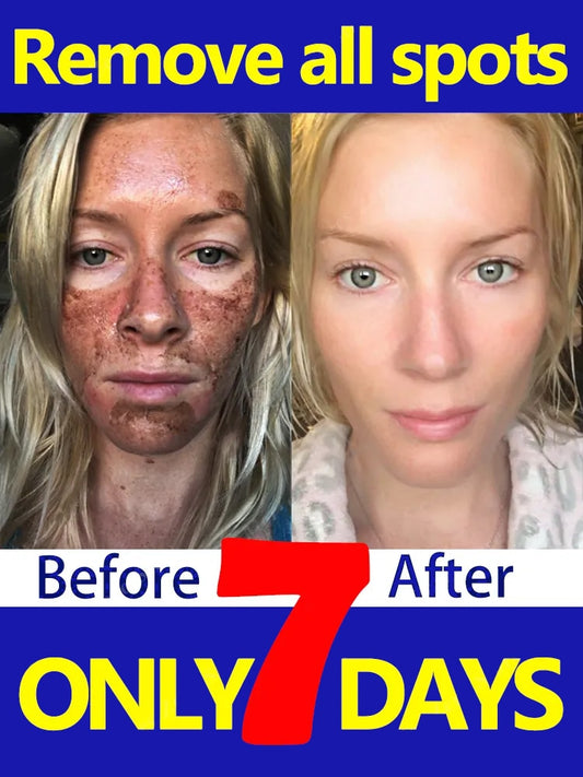Dark Spots Remover Cream Freckles Melasma Sun Age Spot - kmtell.com